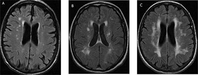 Association between intracranial and extracranial atherosclerosis and white matter hyperintensities: a systematic review and meta-analysis